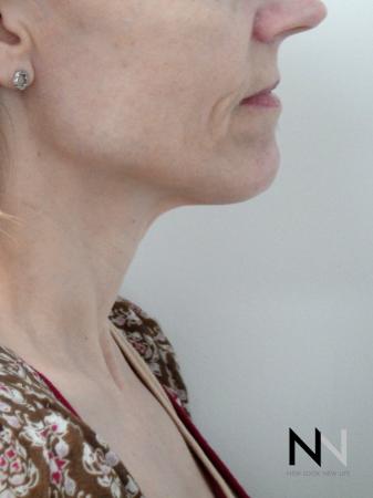 Ultherapy®: Patient 1 - After 2