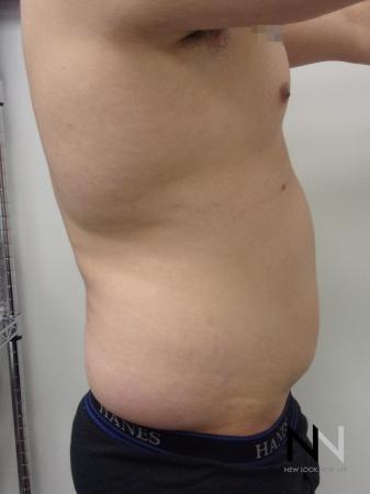 Liposuction: Patient 14 - Before and After Image 3