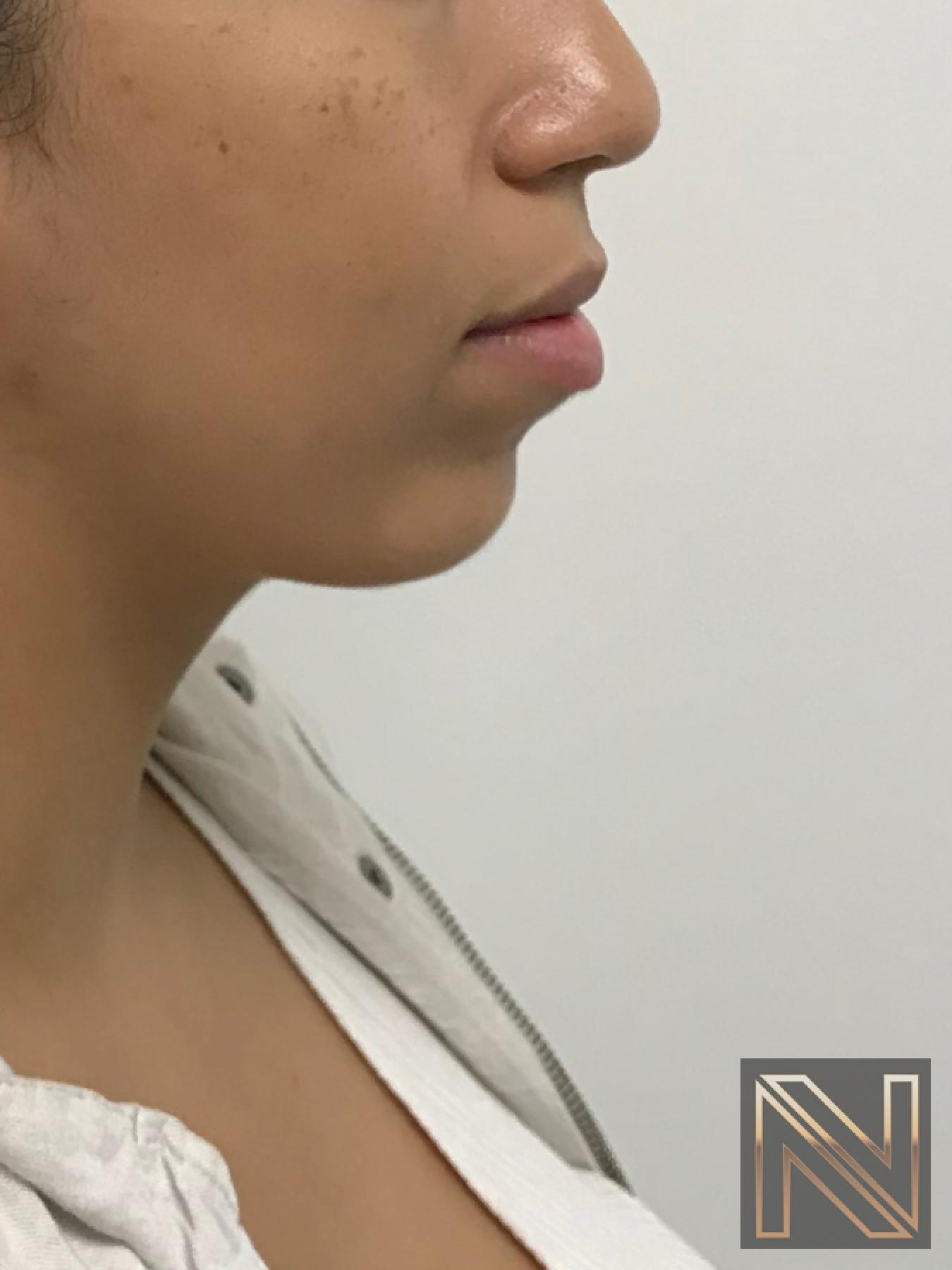 Chin Augmentation: Patient 1 - After 1