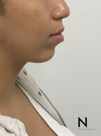 Chin Augmentation: Patient 1 - After Image 1