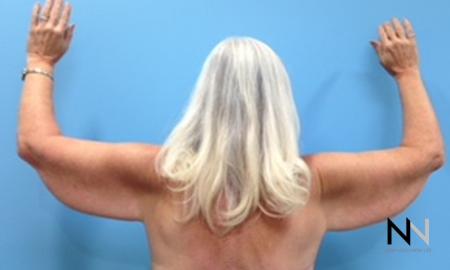 Brachioplasty: Patient 9 - Before and After Image 2