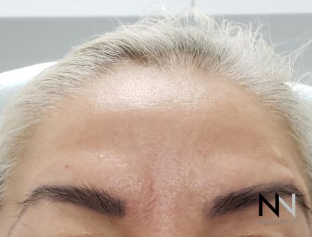 Dysport® : Patient 1 - After Image 1