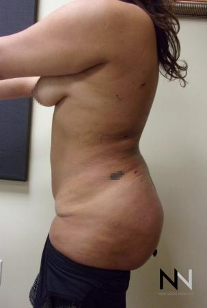 Butt Augmentation: Patient 5 - After Image 2