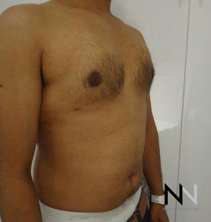 Gynecomastia: Patient 6 - After Image 3