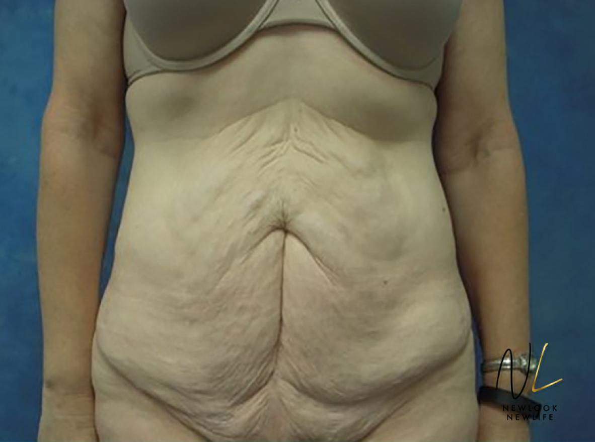 Abdominoplasty: Patient 30 - Before 1