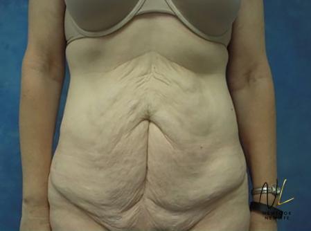 Abdominoplasty: Patient 30 - Before Image 1