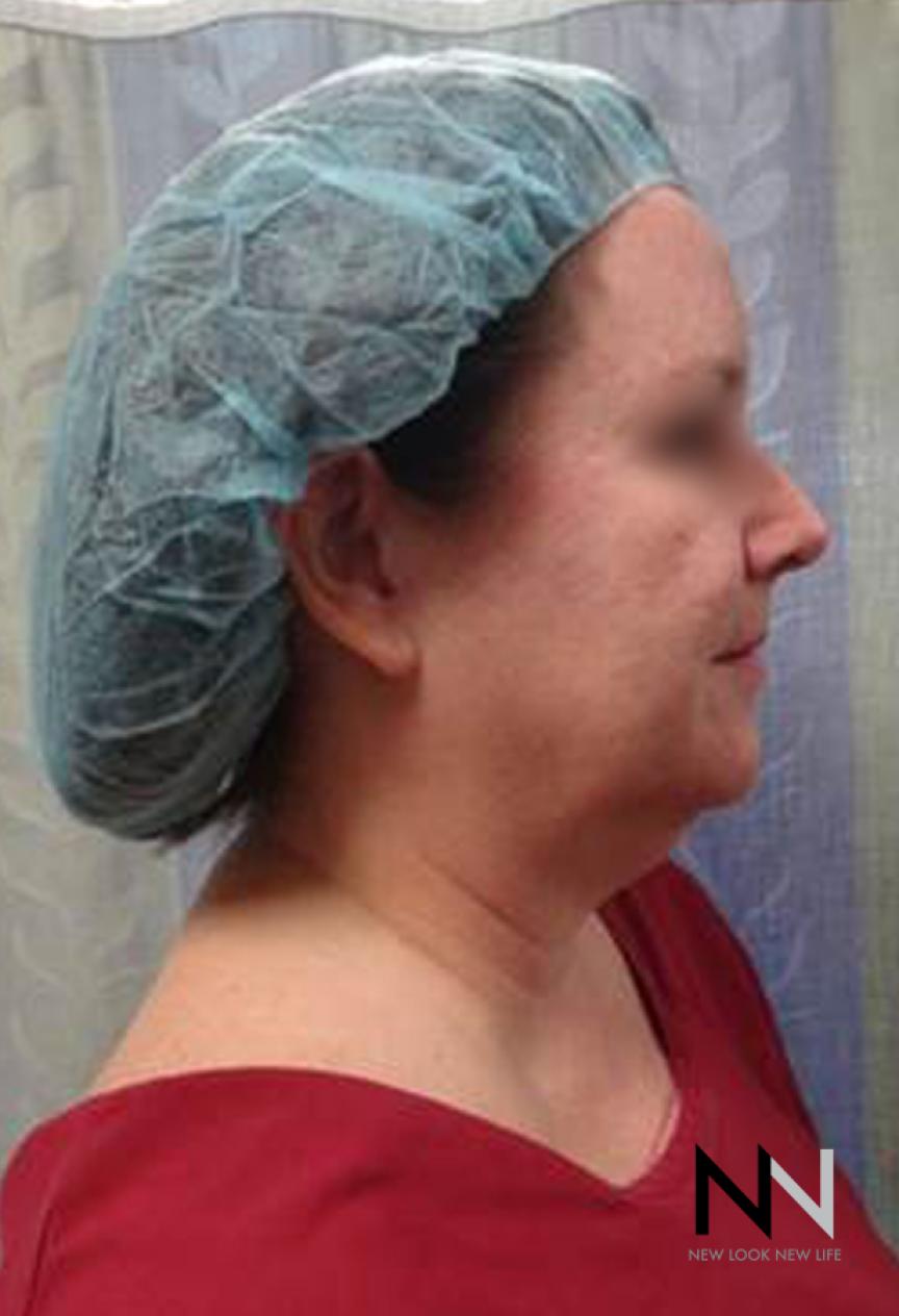 Facelift/Mini Facelift: Patient 4 - Before 