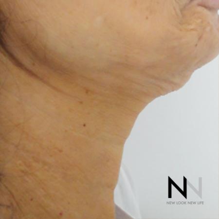 SkinTyte II™: Patient 2 - Before Image 1