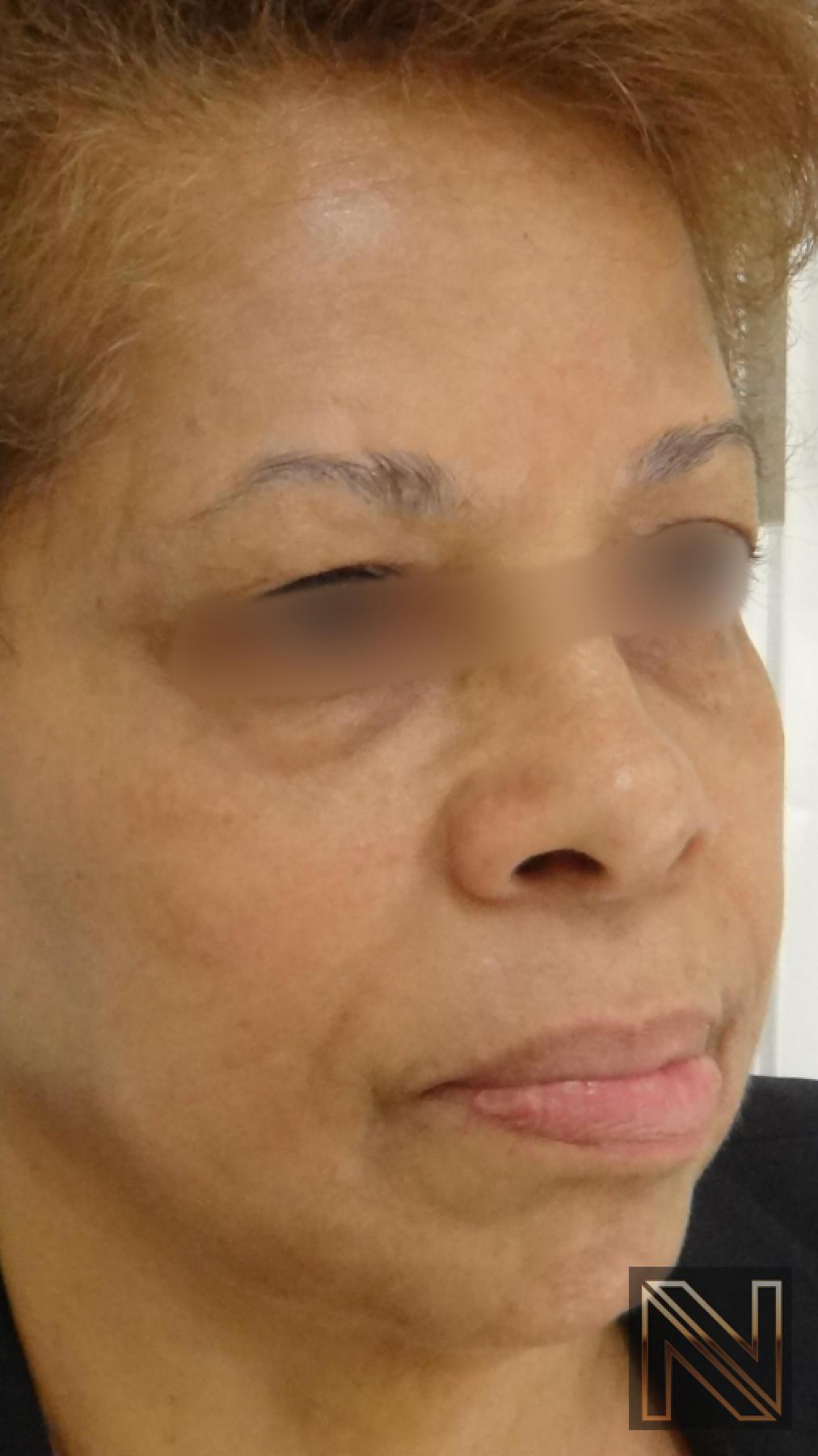 Laser Skin Resurfacing - Face: Patient 2 - After 3