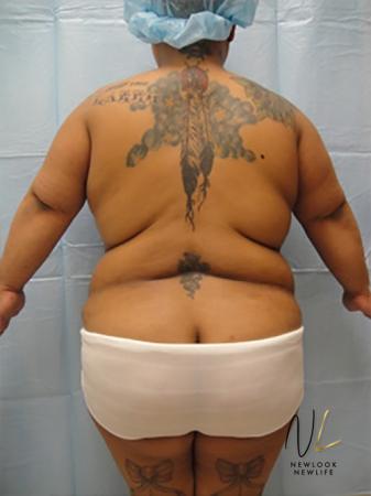 Liposuction: Patient 19 - Before Image 1