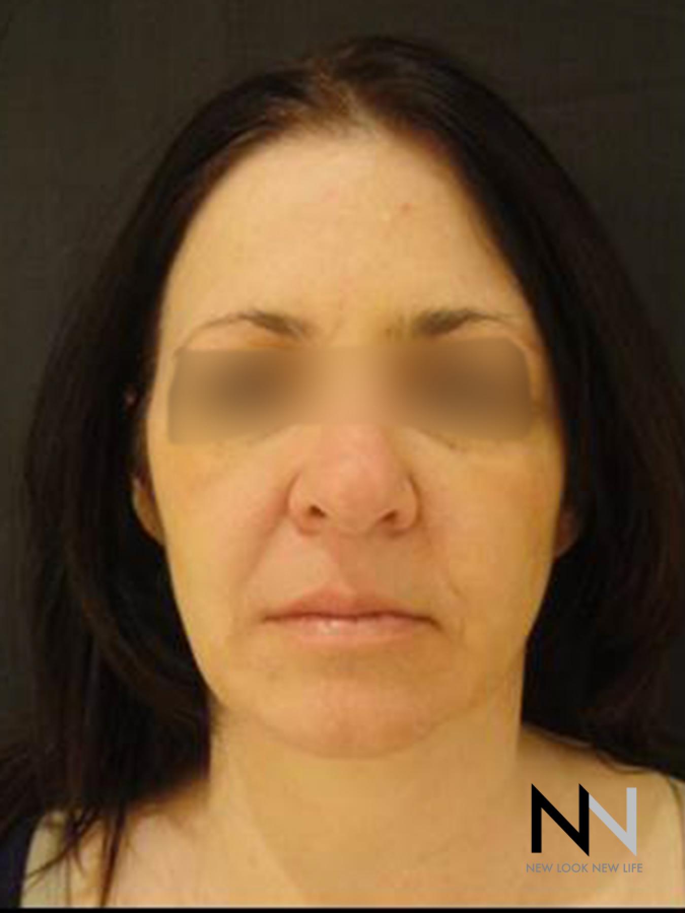 Liquid Facelift: Patient 4 - After  