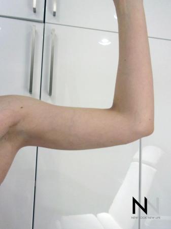 Liposuction: Patient 26 - After Image 2