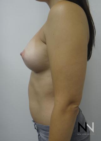 Breast Augmentation: Patient 15 - After Image 5