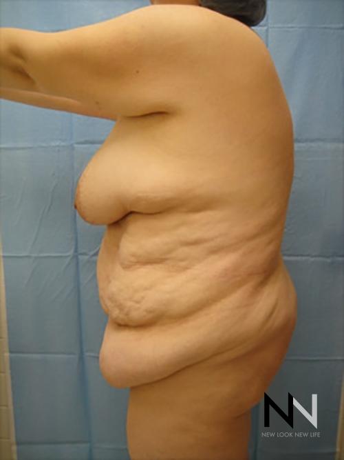 Abdominoplasty: Patient 15 - Before and After 2