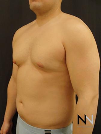 Gynecomastia: Patient 3 - Before Image 2