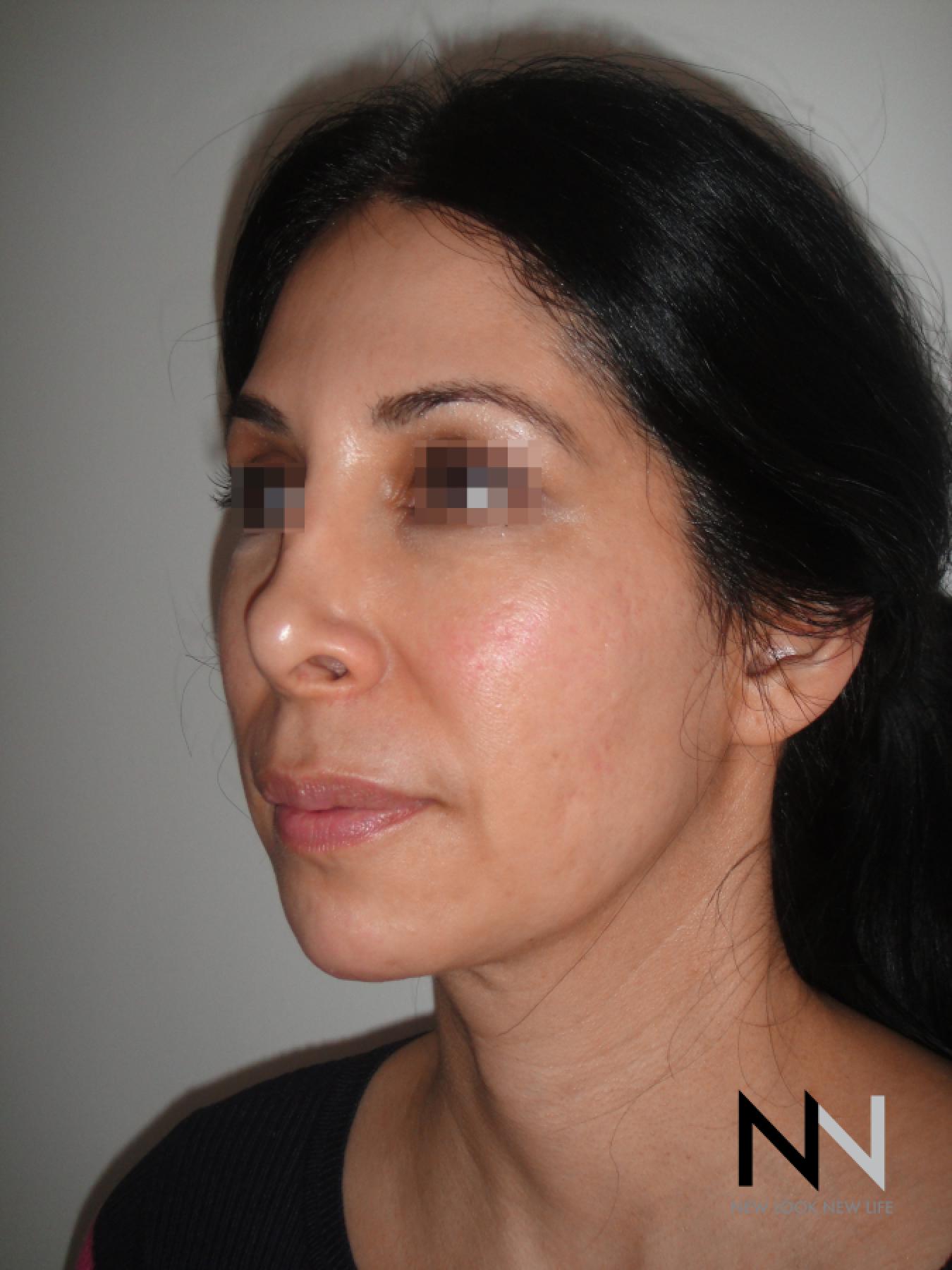 Fractional Resurfacing: Patient 3 - After 1