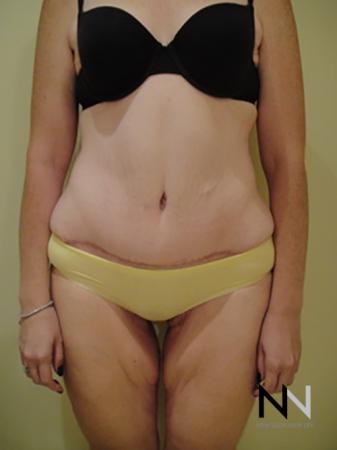 Abdominoplasty: Patient 2 - After Image 1