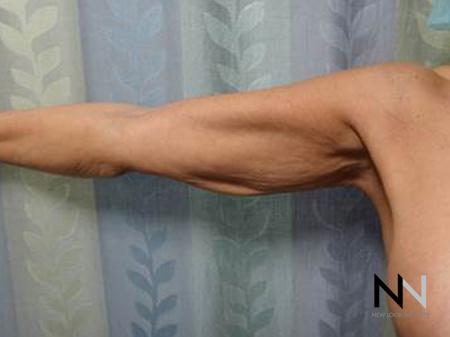 Brachioplasty: Patient 8 - Before Image 1