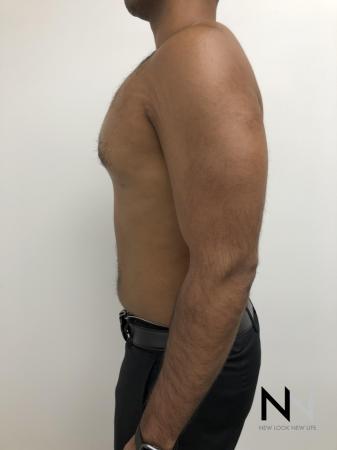 Gynecomastia: Patient 7 - After Image 2