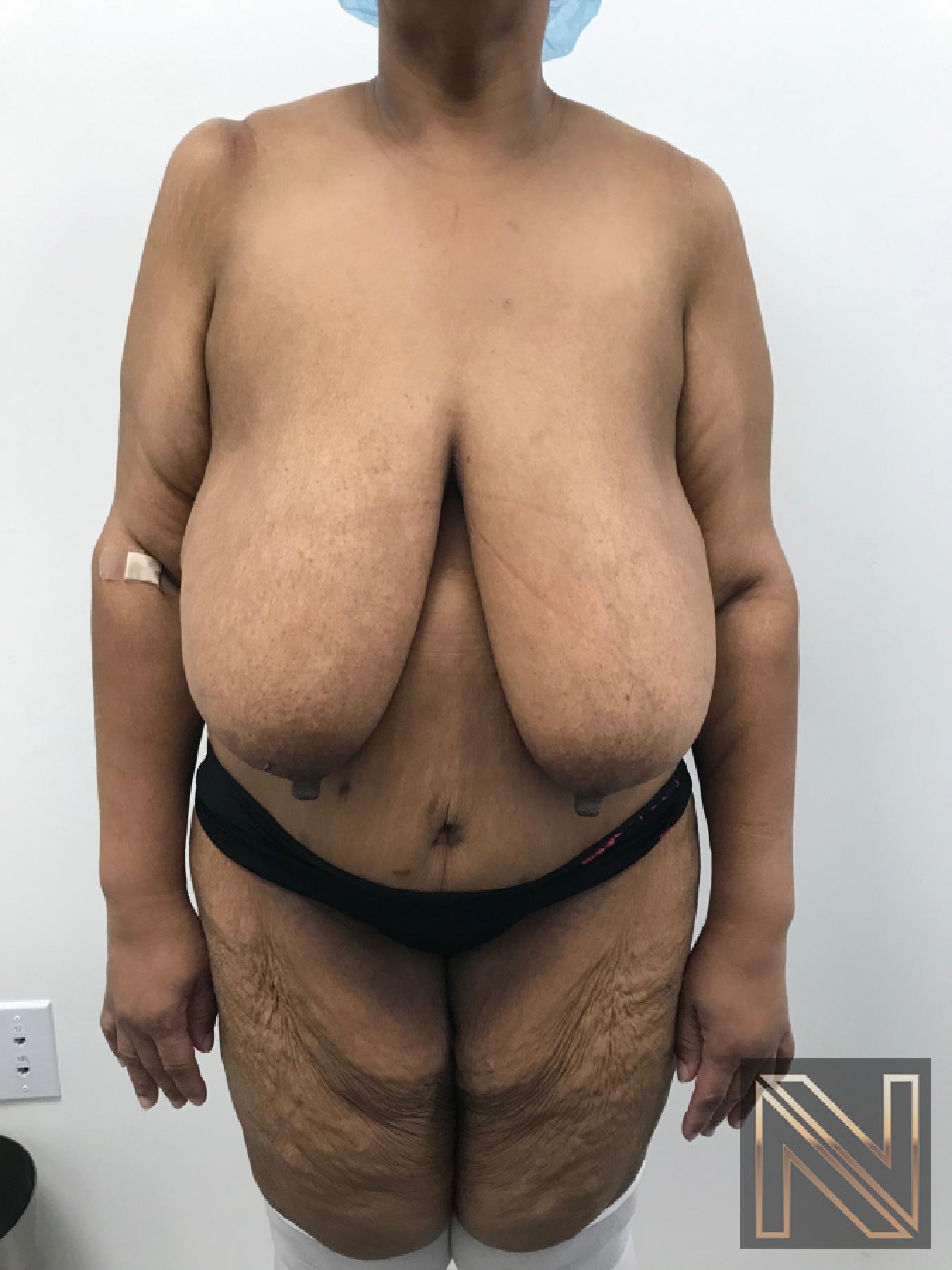 Breast Reduction: Patient 2 - Before 
