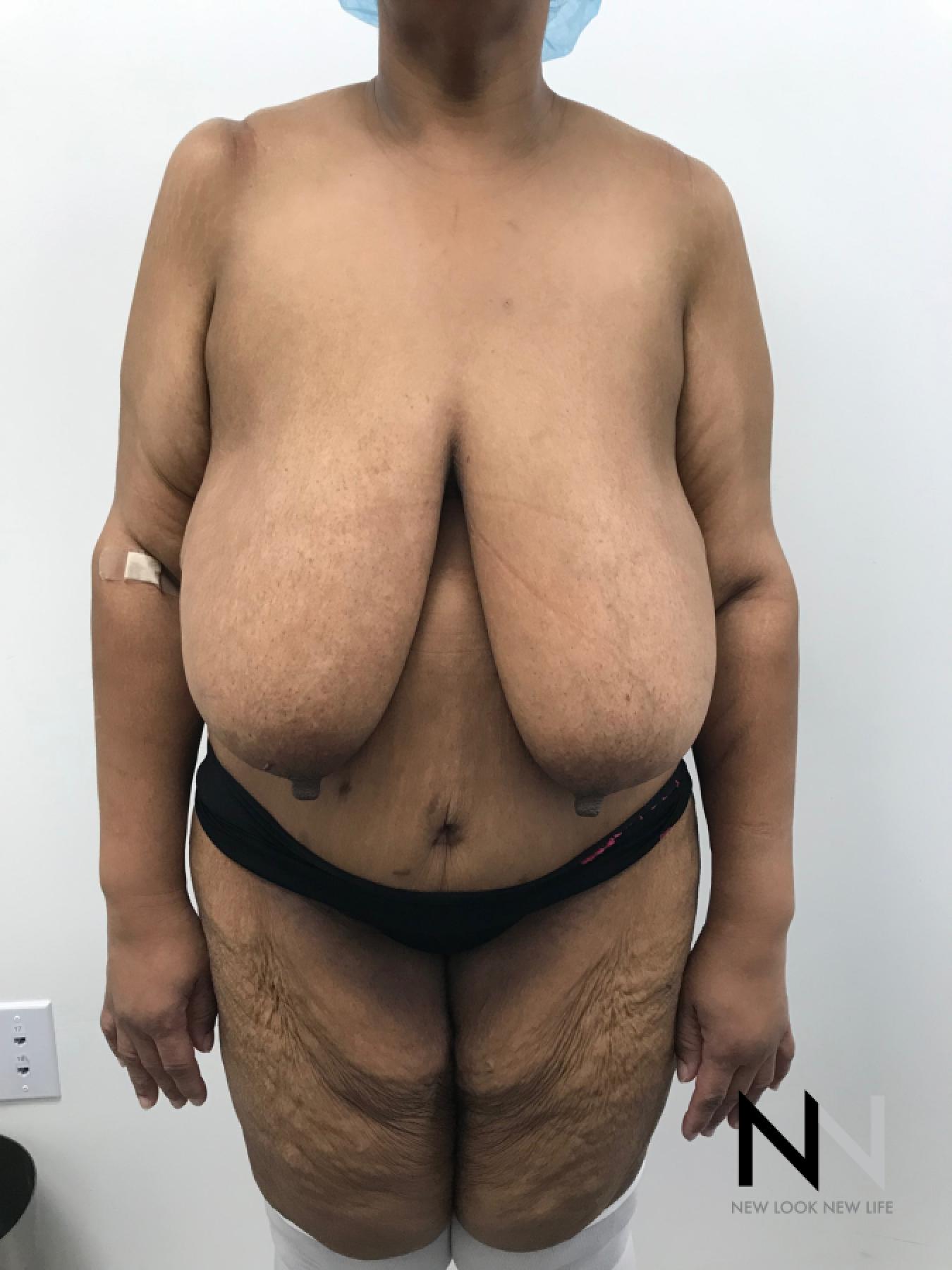 Breast Reduction: Patient 2 - Before 