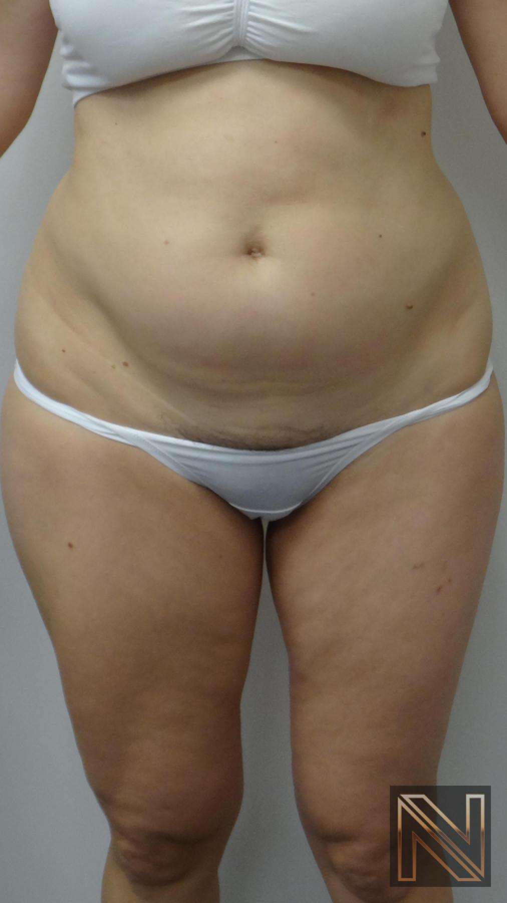 Liposuction: Patient 12 - Before 1