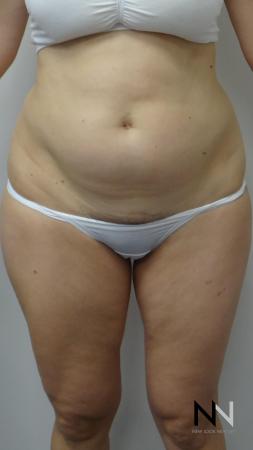 Liposuction: Patient 12 - Before Image