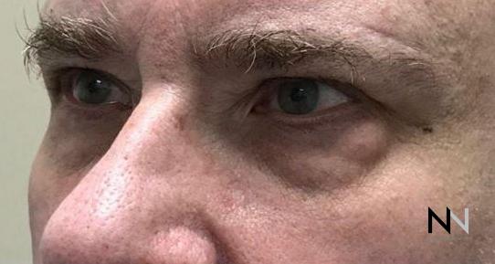 Blepharoplasty: Patient 6 - Before 