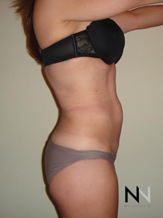 Liposuction: Patient 7 - After Image 3