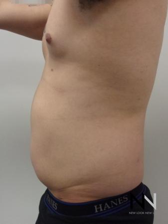 Liposuction: Patient 14 - Before Image 2