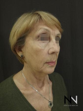 Ultherapy®: Patient 2 - Before Image 2