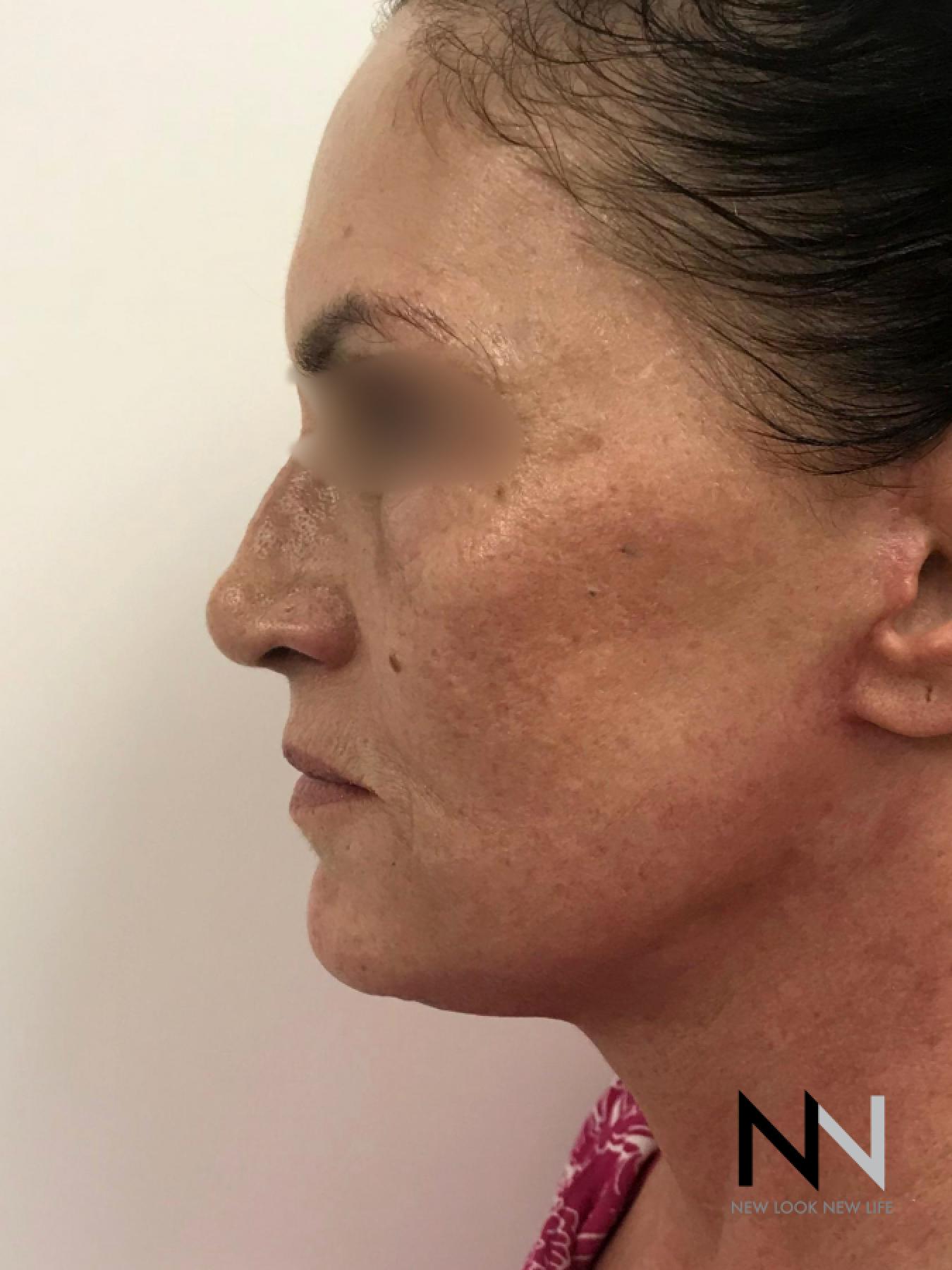 Fractional Resurfacing: Patient 1 - Before 