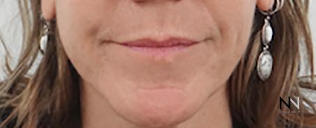 Fillers: Patient 6 - After  