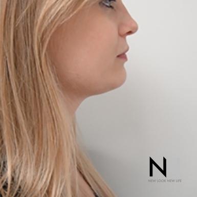 Liposuction: Patient 1 - After Image 5