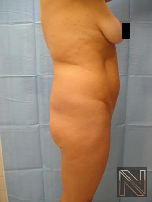 Butt Augmentation: Patient 2 - Before and After 2
