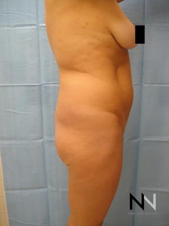 Butt Augmentation: Patient 2 - Before and After Image 2