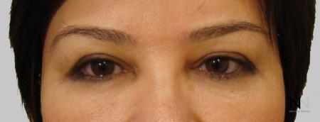 Blepharoplasty: Patient 5 - After Image 1