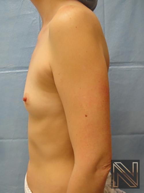 Breast Augmentation: Patient 5 - Before 4
