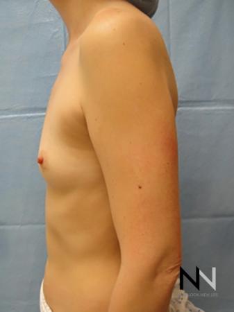 Breast Augmentation: Patient 5 - Before Image 4