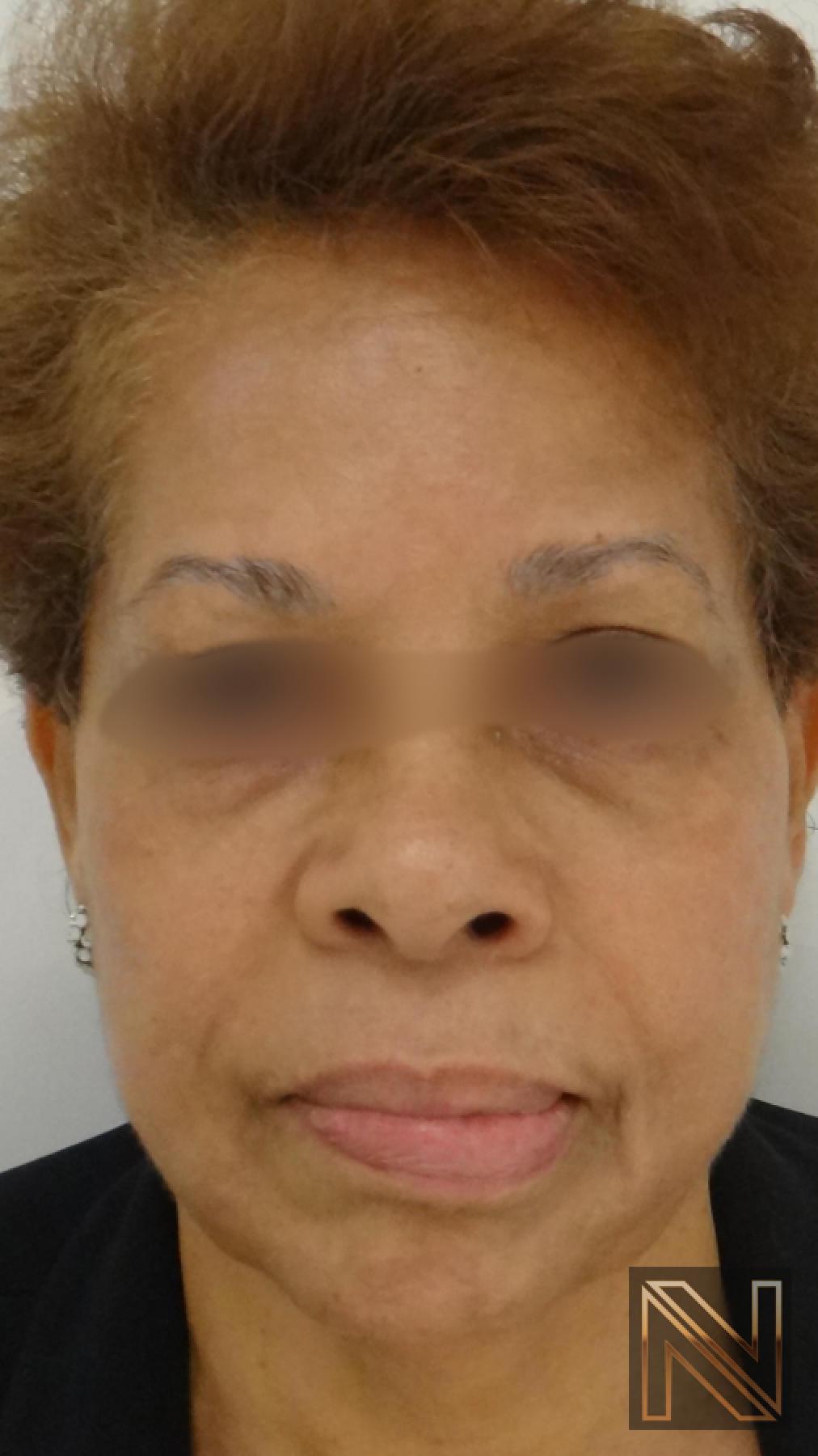 Laser Skin Resurfacing - Face: Patient 2 - After 1