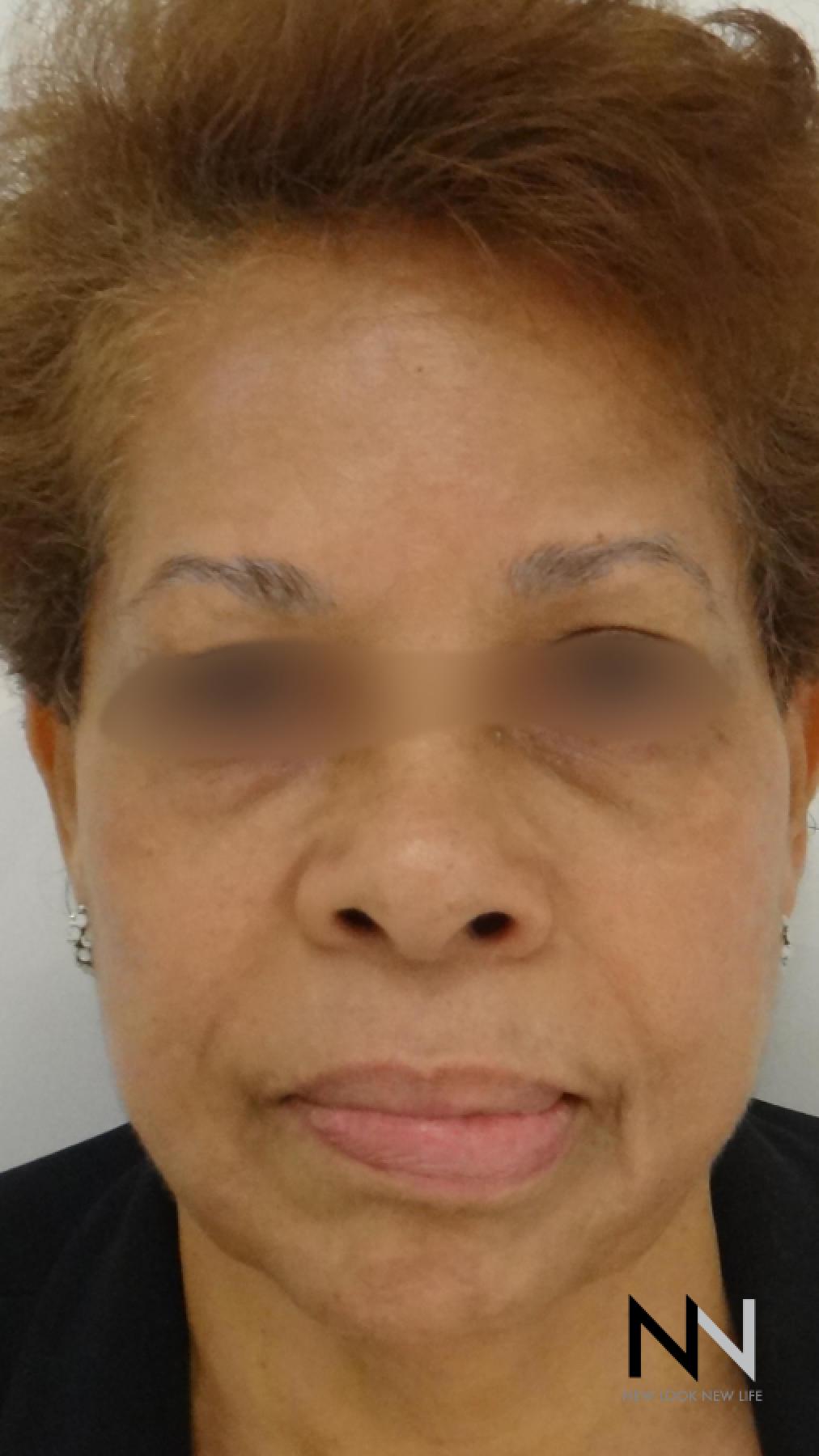 Laser Skin Resurfacing - Face: Patient 2 - After  