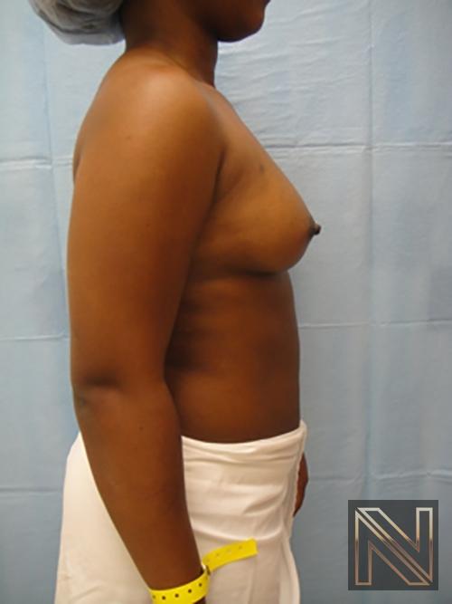 Breast Augmentation: Patient 12 - Before and After 5