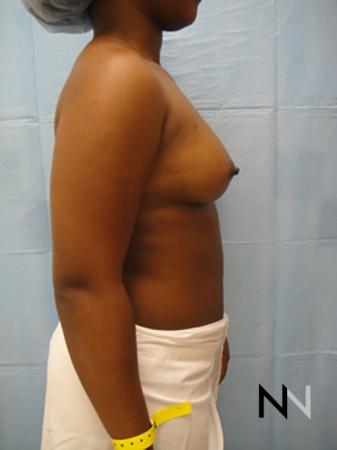 Breast Augmentation: Patient 12 - Before and After Image 5