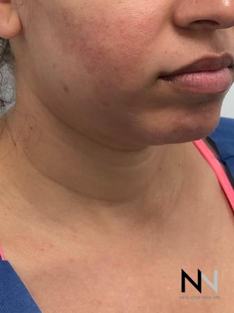 Liposuction: Patient 2 - Before Image 2
