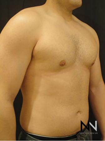 Gynecomastia: Patient 3 - After Image 3