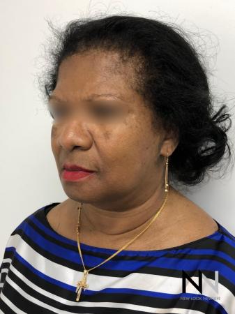 Facelift/Mini Facelift: Patient 7 - After Image 3