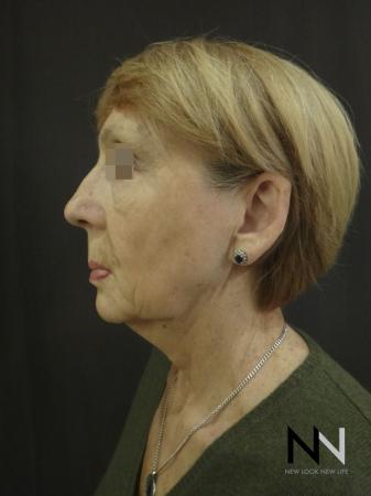 Ultherapy®: Patient 2 - Before and After Image 5