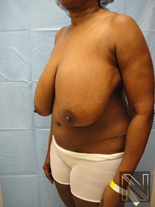 Breast Reduction: Patient 4 - Before 2
