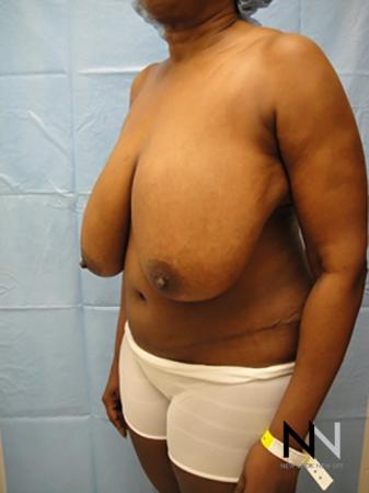 Breast Reduction: Patient 4 - Before Image 2