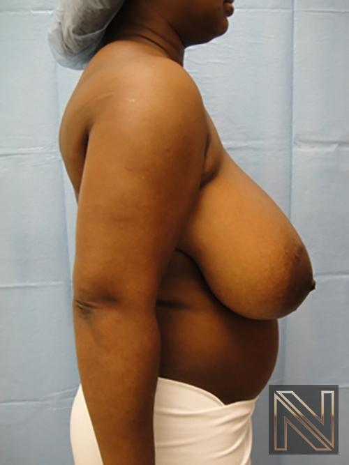 Breast Reduction: Patient 3 - Before and After 5